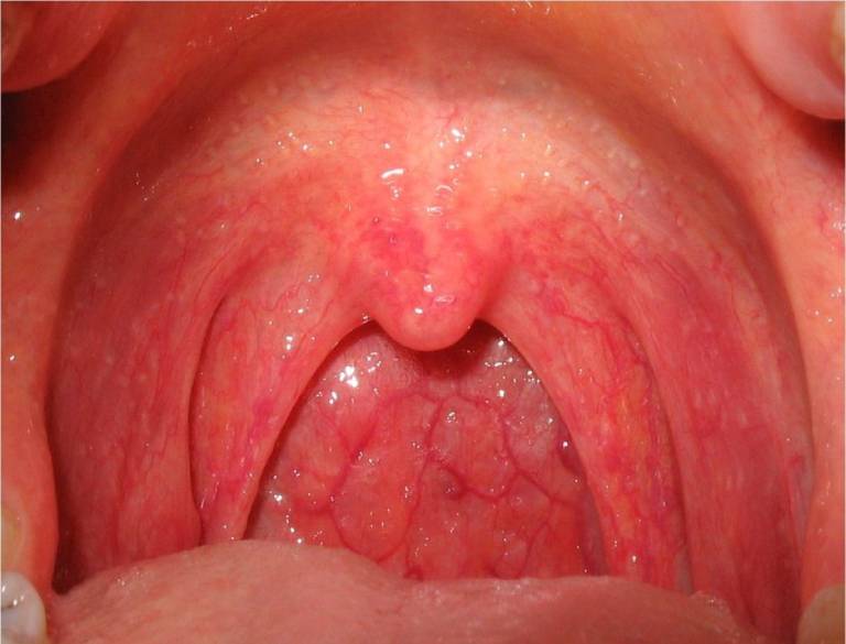Khi bị viêm họng xung huyết niêm mạc họng thường sưng tấy và có màu đỏ đặc trưng