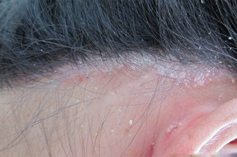 Dấu hiệu bệnh vảy nến da đầu nhẹ và cách điều trị